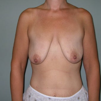 35-44 year old woman treated with Breast Lift with Implants before 1661423