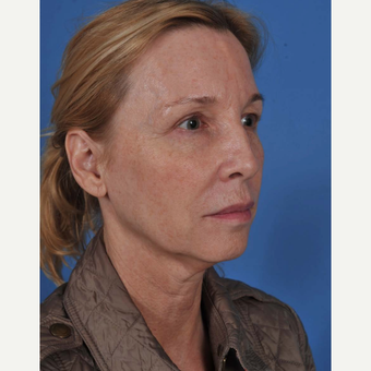 55-64 year old woman treated with Facelift before 3437569
