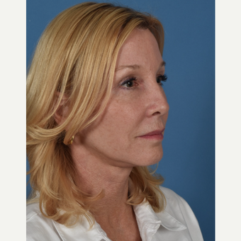 55-64 year old woman treated with Facelift after 3437569