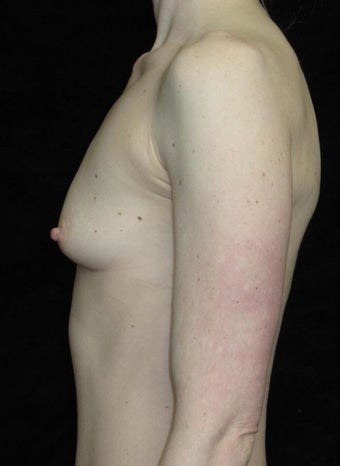 25 year old woman treated with Breast Augmentation 3656541