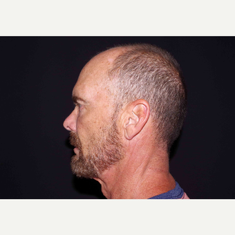 55-64 year old man treated with ArteFill after 3439453