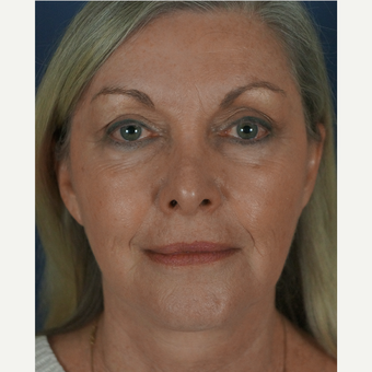 55-64 year old woman treated with Mini Lift 1816316