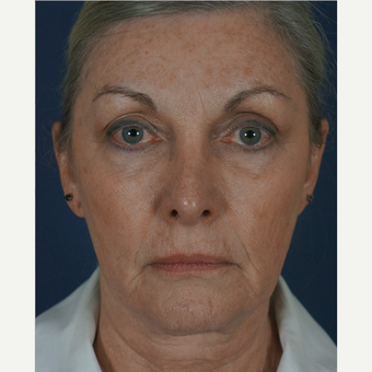55-64 year old woman treated with Mini Lift 1816316