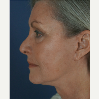 55-64 year old woman treated with Mini Lift after 1816316