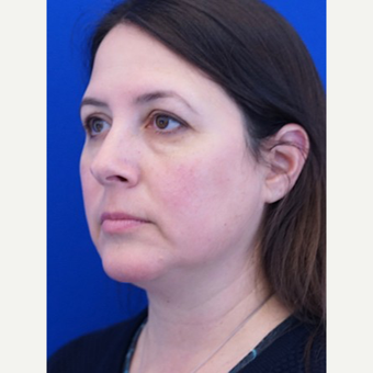 45-54 year old woman treated with Facelift before 3653441