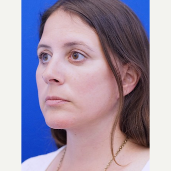 45-54 year old woman treated with Facelift after 3653441