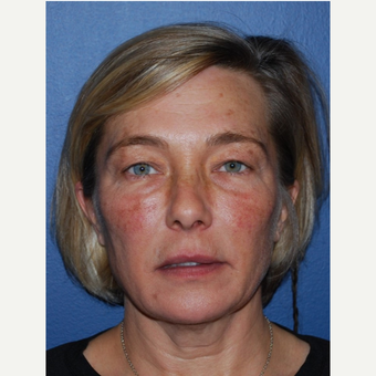 45-54 year old woman treated with Lower Face Lift before 3428281