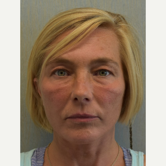 45-54 year old woman treated with Lower Face Lift after 3428281