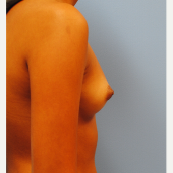20 year old woman treated with saline Breast Implants. A to C with 290 cc high profile filled to 300 before 3304513
