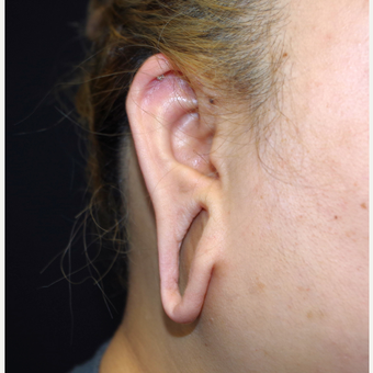 18-24 year old woman treated with Ear Lobe Surgery before 3741680