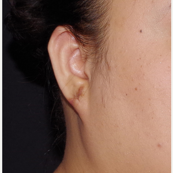 18-24 year old woman treated with Ear Lobe Surgery after 3741680