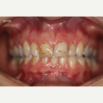 35-44 year old woman treated with Dental Bonding before 3097786