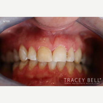35-44 year old woman treated with Dental Bonding after 3097786