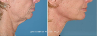 45-54 year old woman treated with Facelift after 3810184