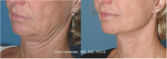 45-54 year old woman treated with Facelift before 3810184