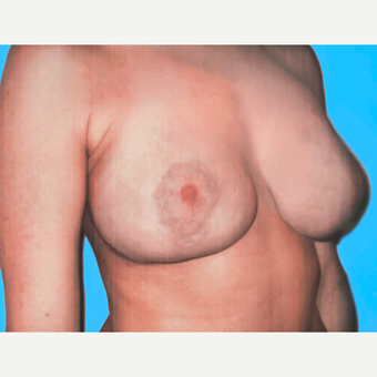 Breast Lift with Implants after 3748878