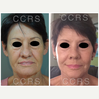 Complete facial rejuvenation of 61 year old woman before 3031222
