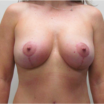 Breast Lift with Implants for this 43 Year Old Woman after 3025280