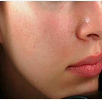 25-34 year old woman treated with Acne Scars Treatment after 1639781