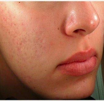 25-34 year old woman treated with Acne Scars Treatment before 1639781