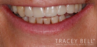 New dental plate after 3097312