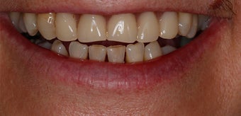 New dental plate before 3097312