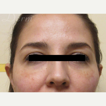 35-44 year old woman treated with Restylane after 3670644