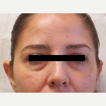 35-44 year old woman treated with Restylane before 3670644