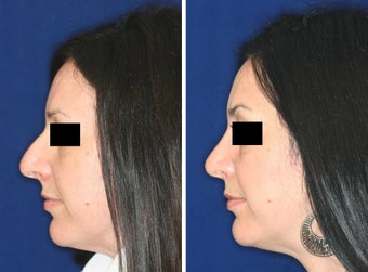 Nose Surgery before 1430818