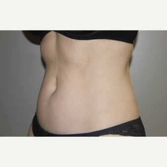 35-44 year old woman treated with SculpSure after 3706722