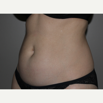 35-44 year old woman treated with SculpSure before 3706722