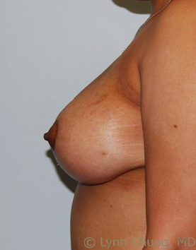 Female in her late 30's-Breast Lift with Implants 1277641