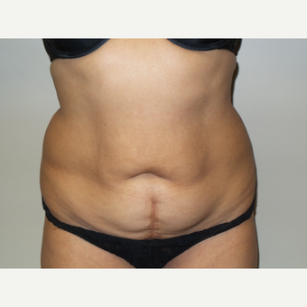 56 year old woman treated with Tummy Tuck before 2902623