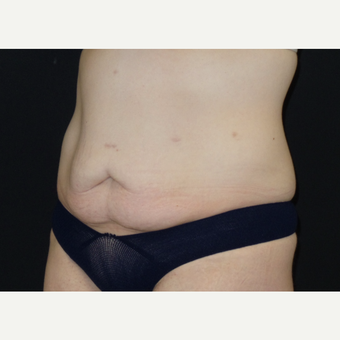 25-34 year old woman treated with Tummy Tuck before 3094371