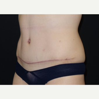 25-34 year old woman treated with Tummy Tuck after 3094371