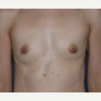 35-44 year old woman treated with Breast Implants before 3455301