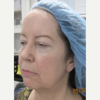 45-54 year old woman treated with Radiesse and Belotero before 3059522