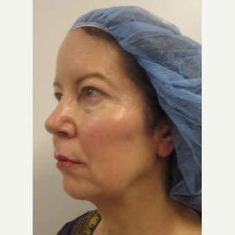 45-54 year old woman treated with Radiesse and Belotero after 3059522