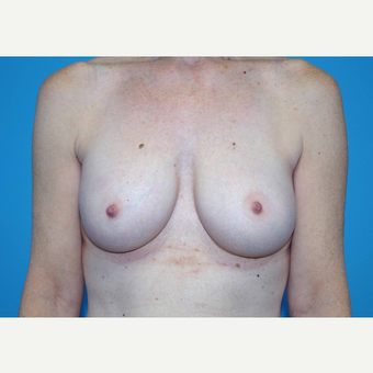45-54 year old woman treated with Breast Implants after 3440056