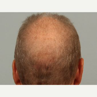 62 year old man treated with Hair Loss Treatment with microneedling and proprietary topical serum before 3453049