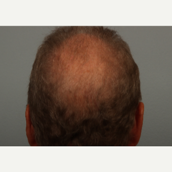 62 year old man treated with Hair Loss Treatment with microneedling and proprietary topical serum after 3453049