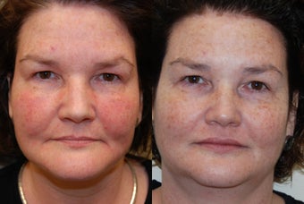 Silikon-1000 for Lip Augmentation and Marionette Grooves. before 1036187