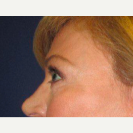 45-54 year old woman treated with Brow Lift after 3776222