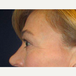 45-54 year old woman treated with Brow Lift before 3776222