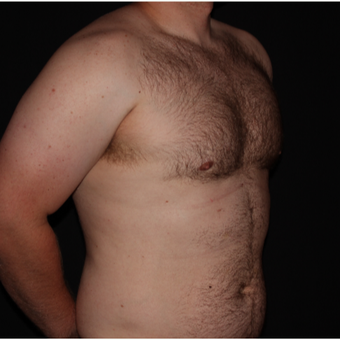 25-34 year old man treated with Male Breast Reduction after 3186590