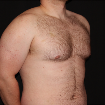 25-34 year old man treated with Male Breast Reduction before 3186590
