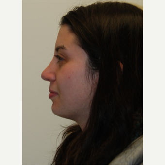 18-24 year old woman treated with Rhinoplasty after 3813736