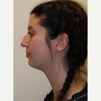 18-24 year old woman treated with Rhinoplasty before 3813736