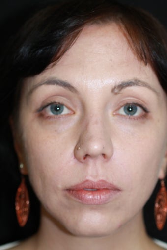 Woman treated with Restylane after 1199172