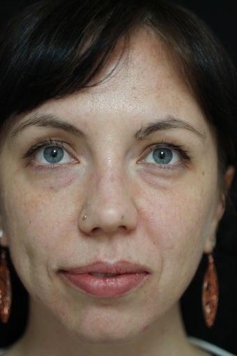 Woman treated with Restylane before 1199172